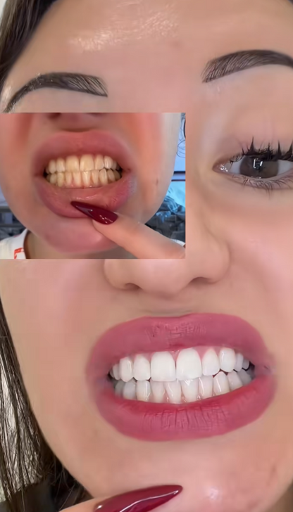 Bande de Blanchiment Optique PAP+ (Zéro Sensibilité)