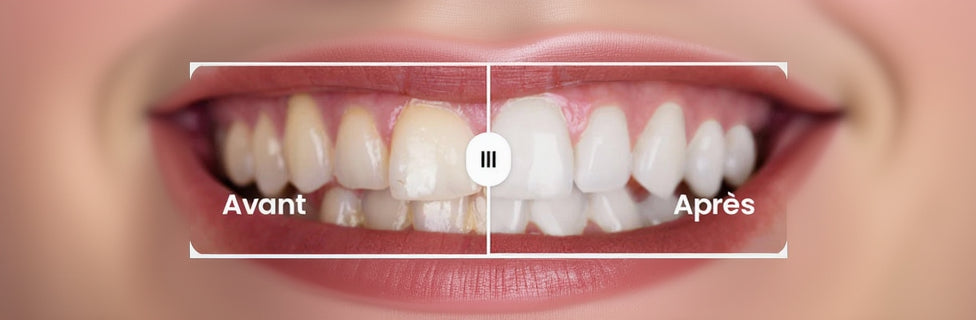 Bande de Blanchiment Optique PAP+ (Zéro Sensibilité)